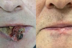 Актиническая кератома губы до и после удаления