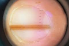 дерматоскопия невуса ногтевого ложа