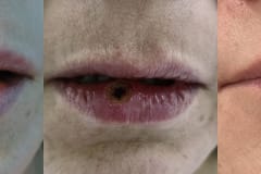 Невус нижней губы до, сразу после удаления и через 1 месяц