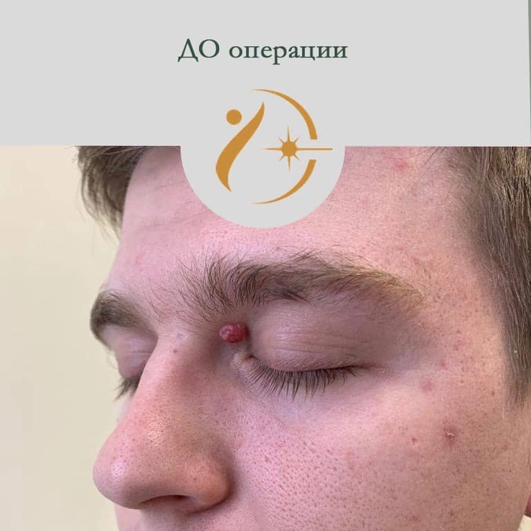 удаление родинок невусов саратов